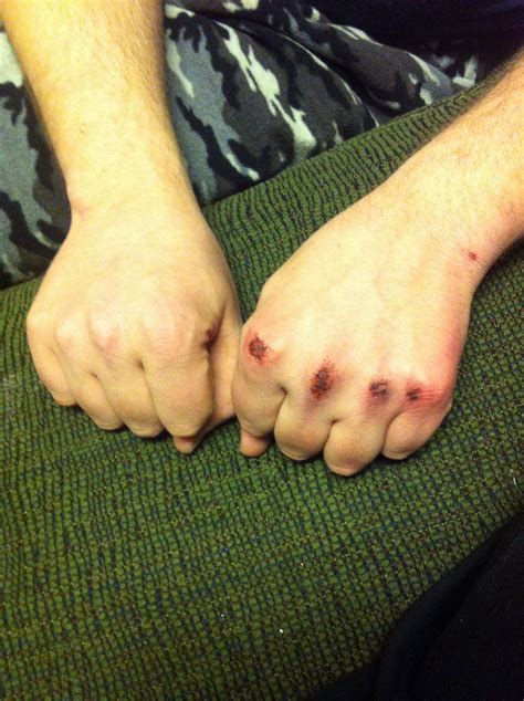 About: Bloody knuckles .